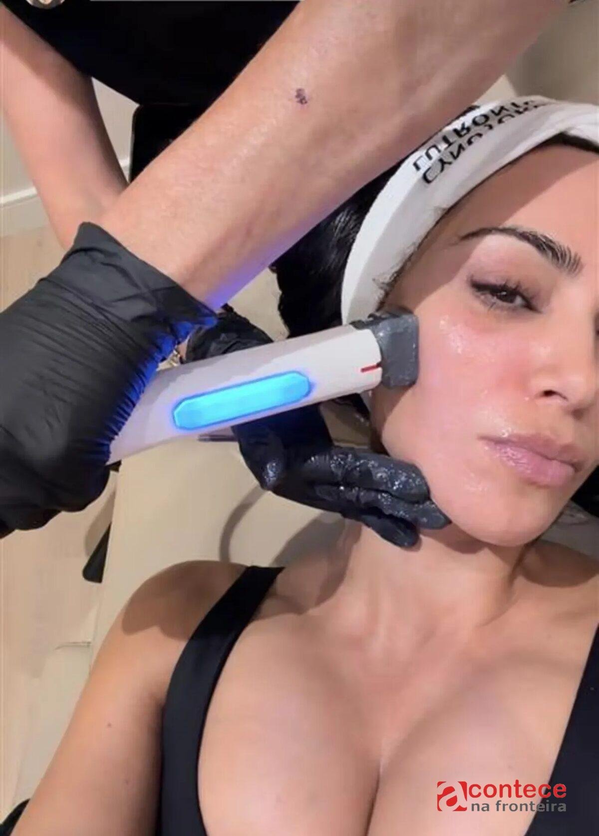 XERF: Conheça o tratamento de pele queridinho de Kim Kardashian