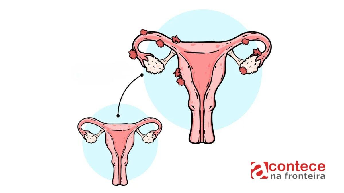 Endometriose profunda: saiba quais sinais afetam múltiplos órgãos